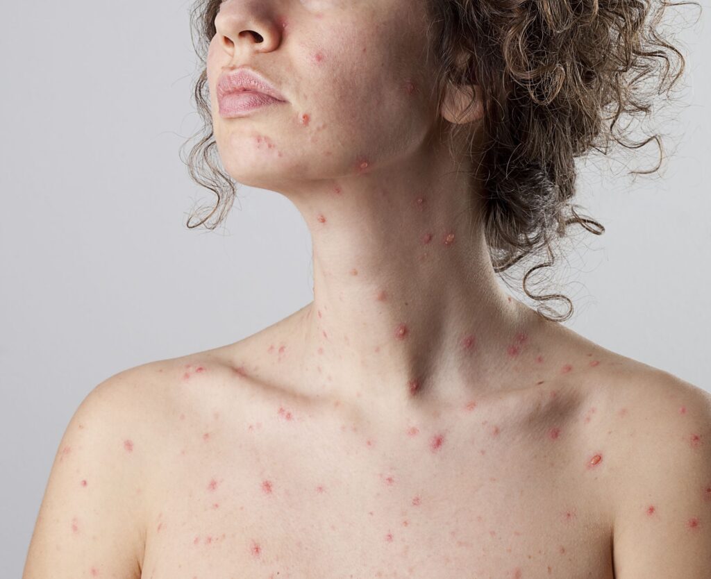 Agurzil treatment cure for adult chicken pox